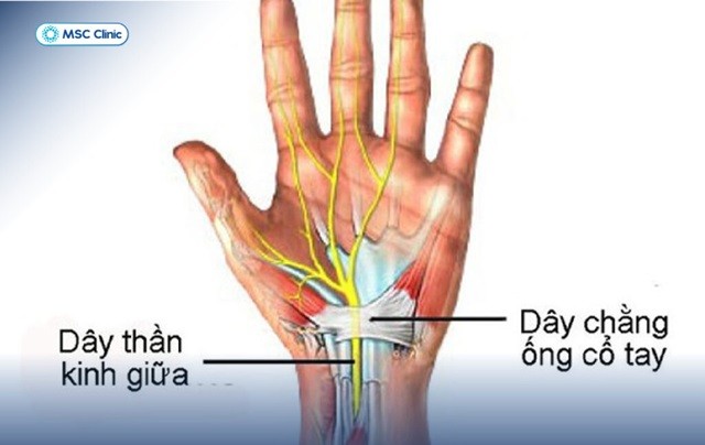 gian-day-chang-co-tay-co-the-xay-ra-do-nhieu-nguyen-nhan-1747986964.jpg